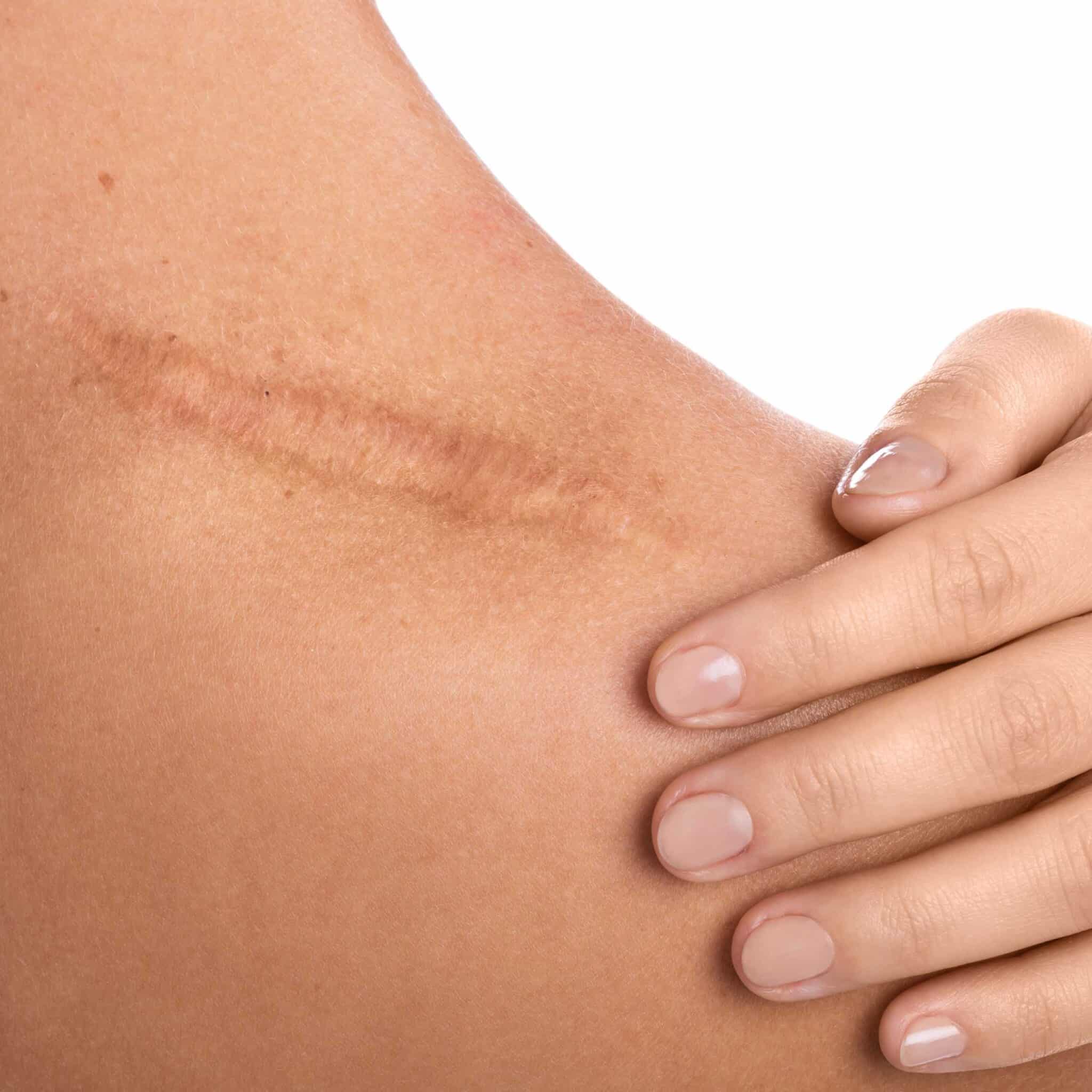 cicatrice-traitement-laser-radiofrequence-microneedling-seance-confidence-clinique-esthetique-lille-5