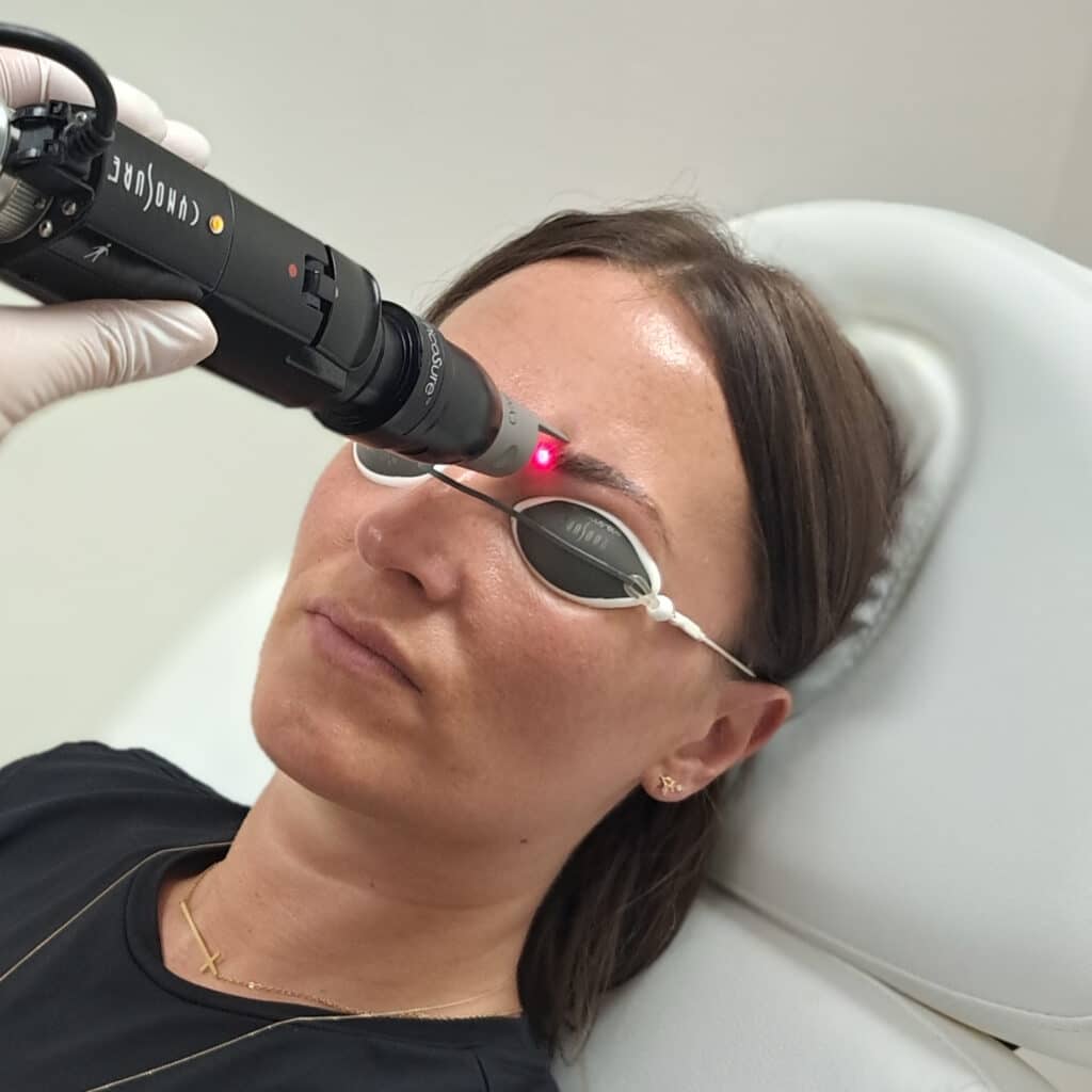 enlever-maquillage-permanant-rate-microblading-resultat-avant-apres-avis-lille-laser-picoseconde-seance-picosure-pro