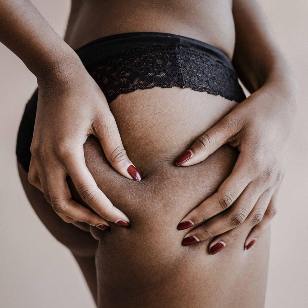 vergeture-traitement-fesses-seins-grossesse-lignes-effacer-confidence-clinique-esthetique-lille-marcq-en-baroeul-2