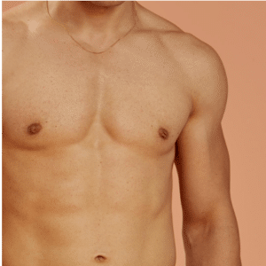 Epilation-laser-definitive-homme-maillot-torse-dos-epaules-barbe-nuque-16