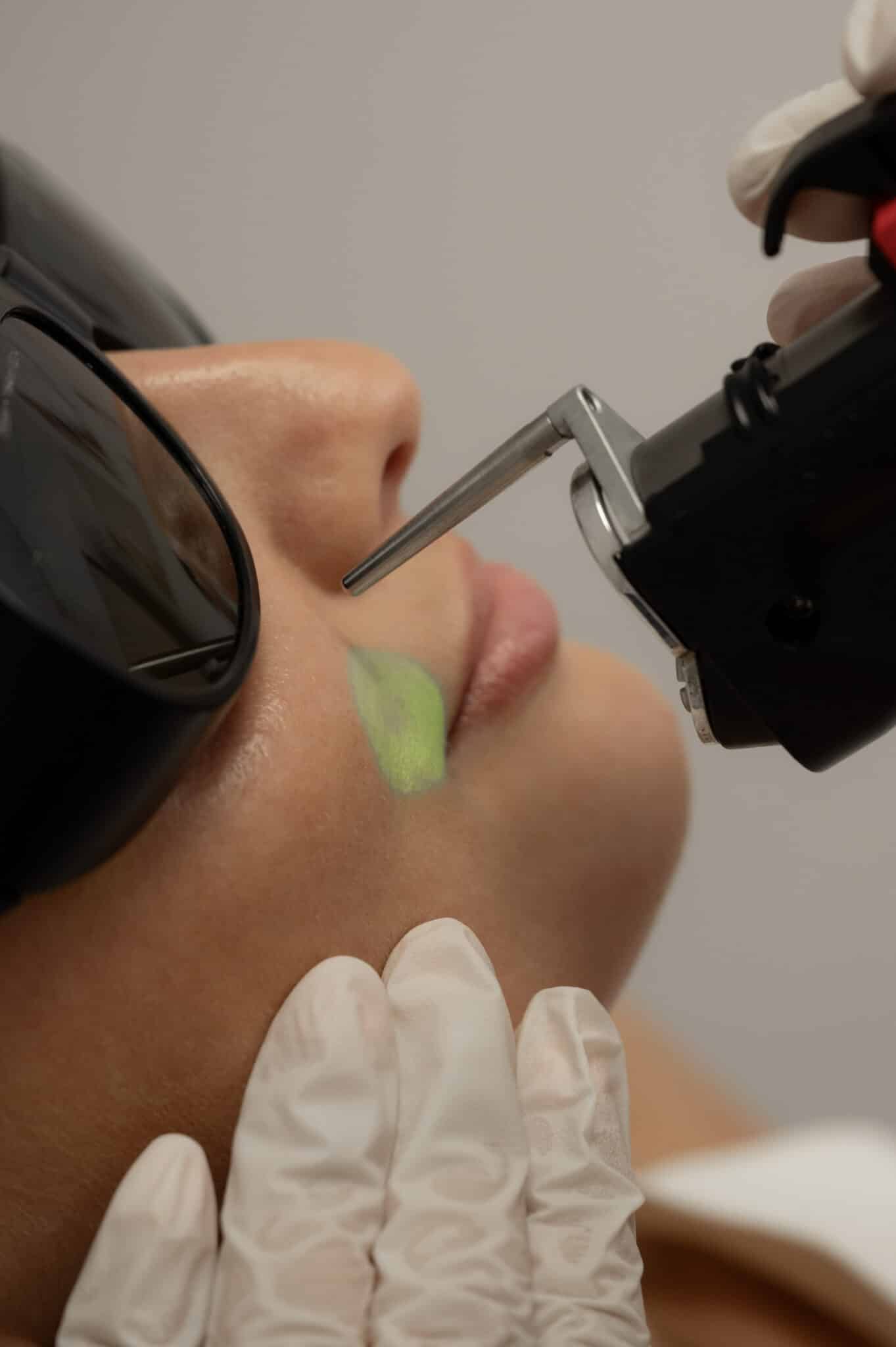 epilation-laser-remboursee-assurance-maladie-cpam-securite-sociale-hirsutisme-pilosite-excessive-10