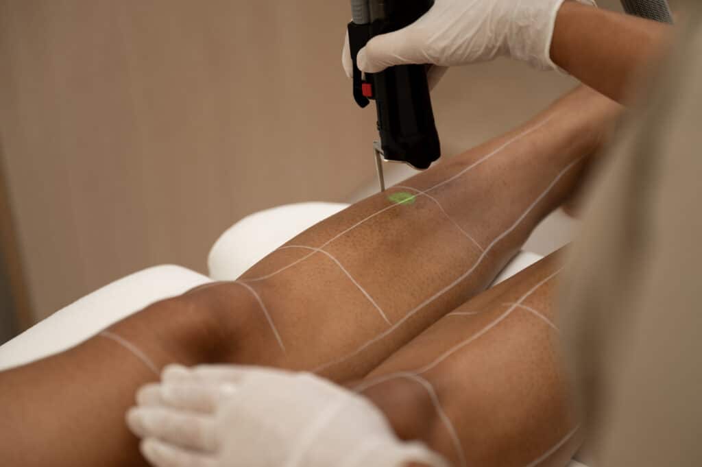 epilation-laser-remboursee-assurance-maladie-cpam-securite-sociale-hirsutisme-pilosite-excessive-11