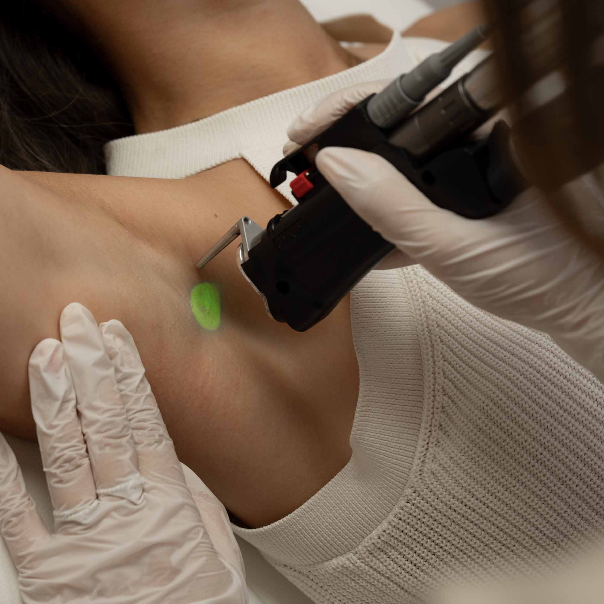 epilation-laser-remboursee-assurance-maladie-cpam-securite-sociale-hirsutisme-pilosite-excessive-19
