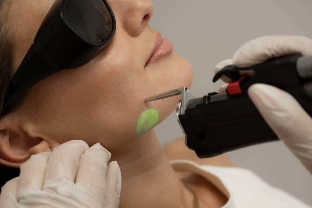 epilation-laser-remboursee-assurance-maladie-cpam-securite-sociale-hirsutisme-pilosite-excessive-9