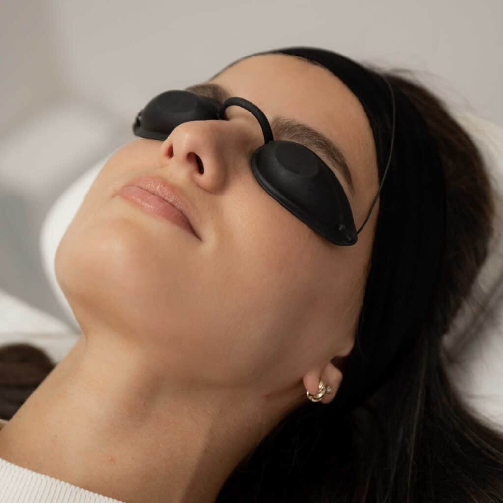 Acne-traitement-kleresca-cicatrice-severe-peau-visage-clinique-confidence-marcq-lille-1