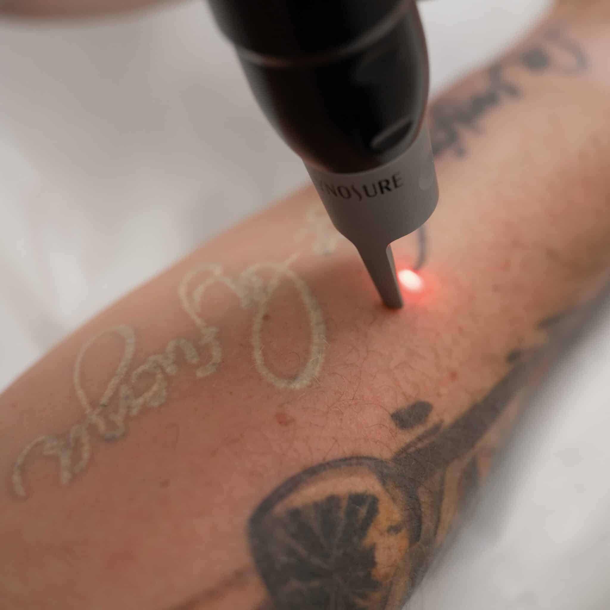 detatouage-laser-lille-picosure-pro-picoseconde-q-switch-switched-pas-cher-enlever-effacer-tatouage-tattoo