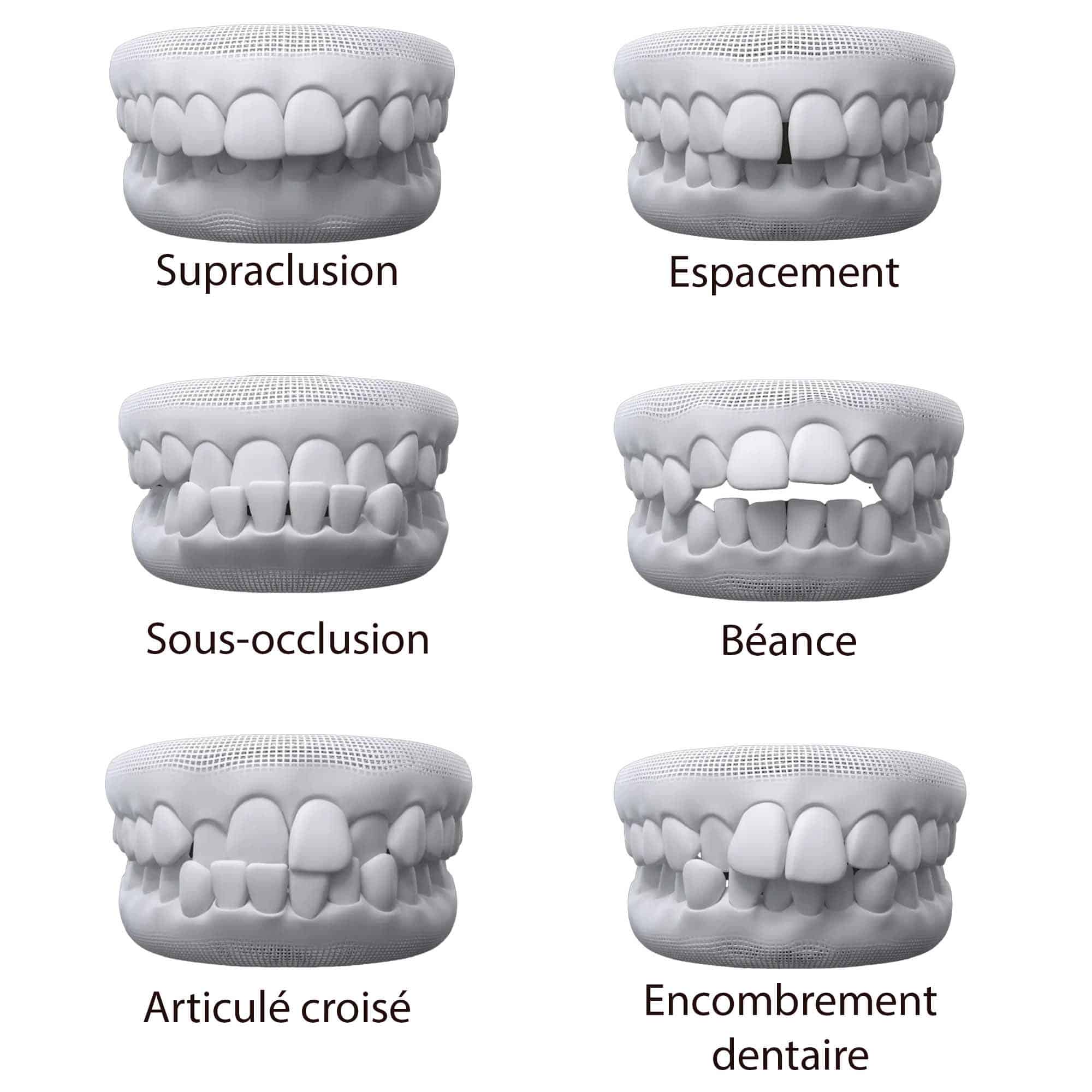 Invisalign-dentiste-lille-marcq-en-baroeul-avis-client-google-gouttieres-avant-apres-prix-occlusion