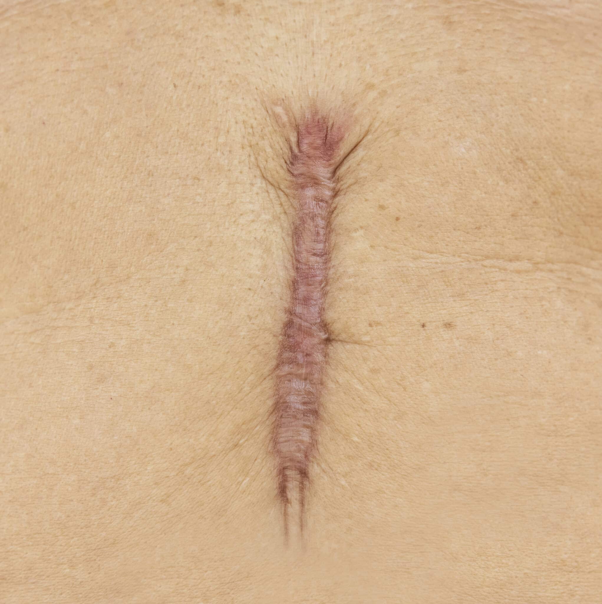 cicatrice-cheloide-lille-traitement-efficace-effacer-chirurgie-clinique-confidence-02