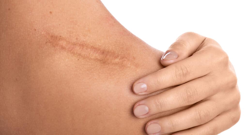 cicatrice-cheloide-lille-traitement-efficace-effacer-chirurgie-clinique-confidence-031