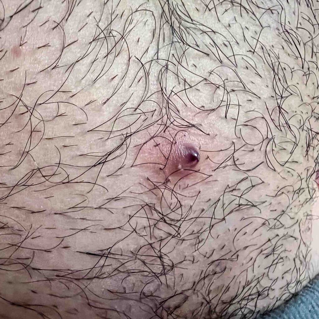 poil-incarne-maillot-pubis-visage-jambe-barbe-traitement-enlever-epilation-laser-definitive-clinique-confidence-lille-02