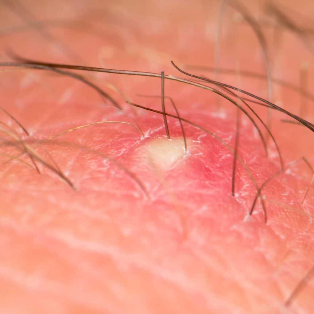 poil-incarne-maillot-pubis-visage-jambe-barbe-traitement-enlever-epilation-laser-definitive-clinique-confidence-lille-03