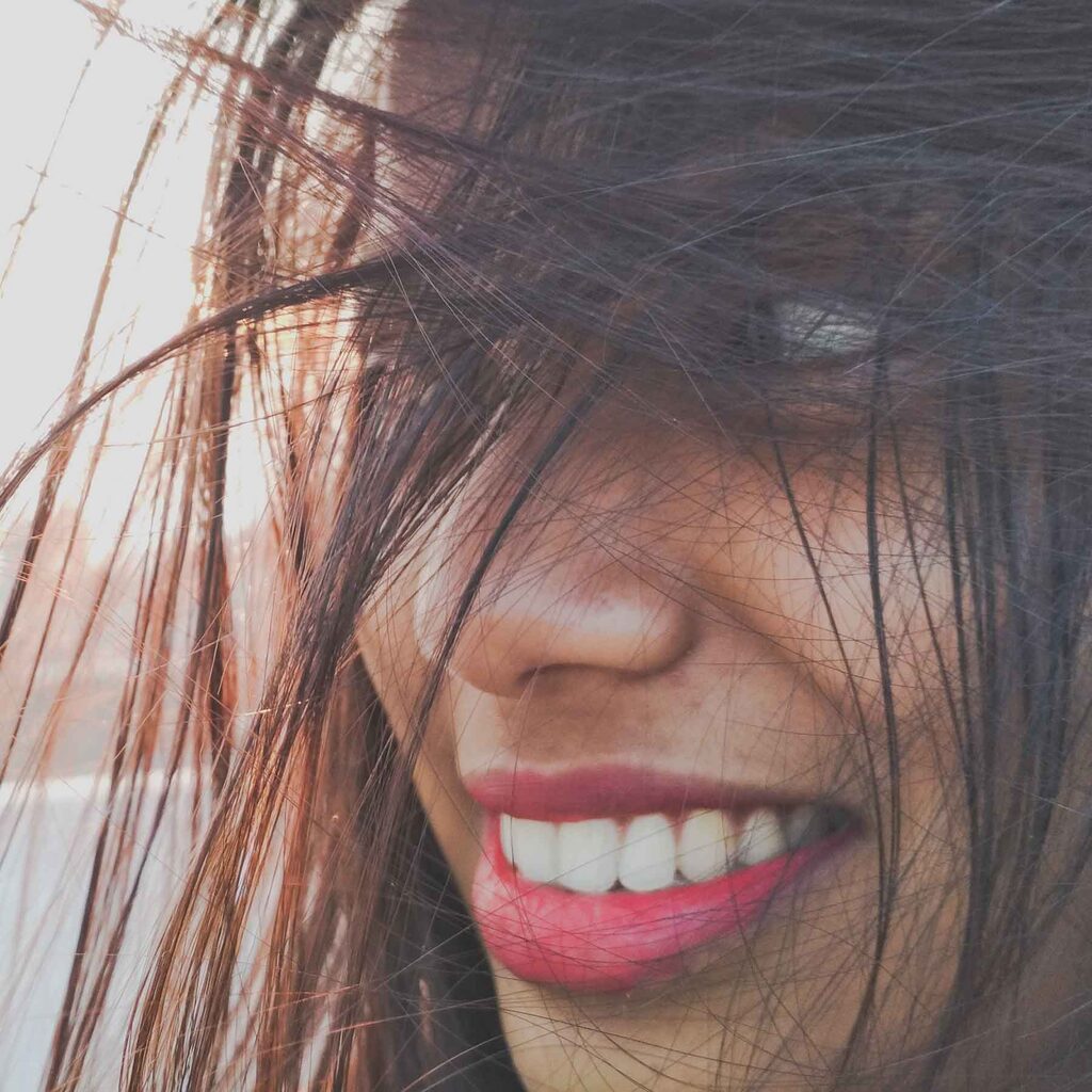 sourire-gingival-botox-acide-hyaluronique-gencive-toxine-botulique-clinique-confidence-lille-marcq-en-baroeul-03