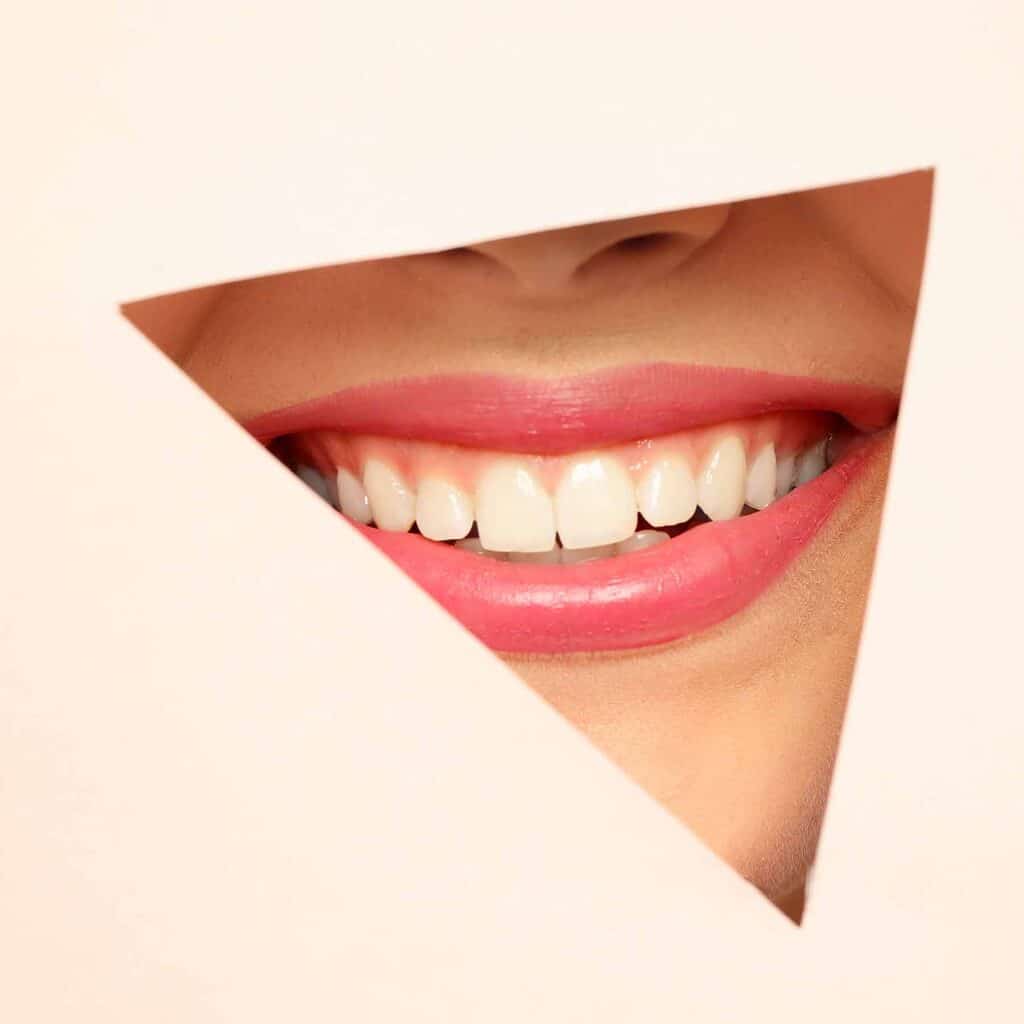 sourire-gingival-botox-acide-hyaluronique-gencive-toxine-botulique-clinique-confidence-lille-marcq-en-baroeul-12