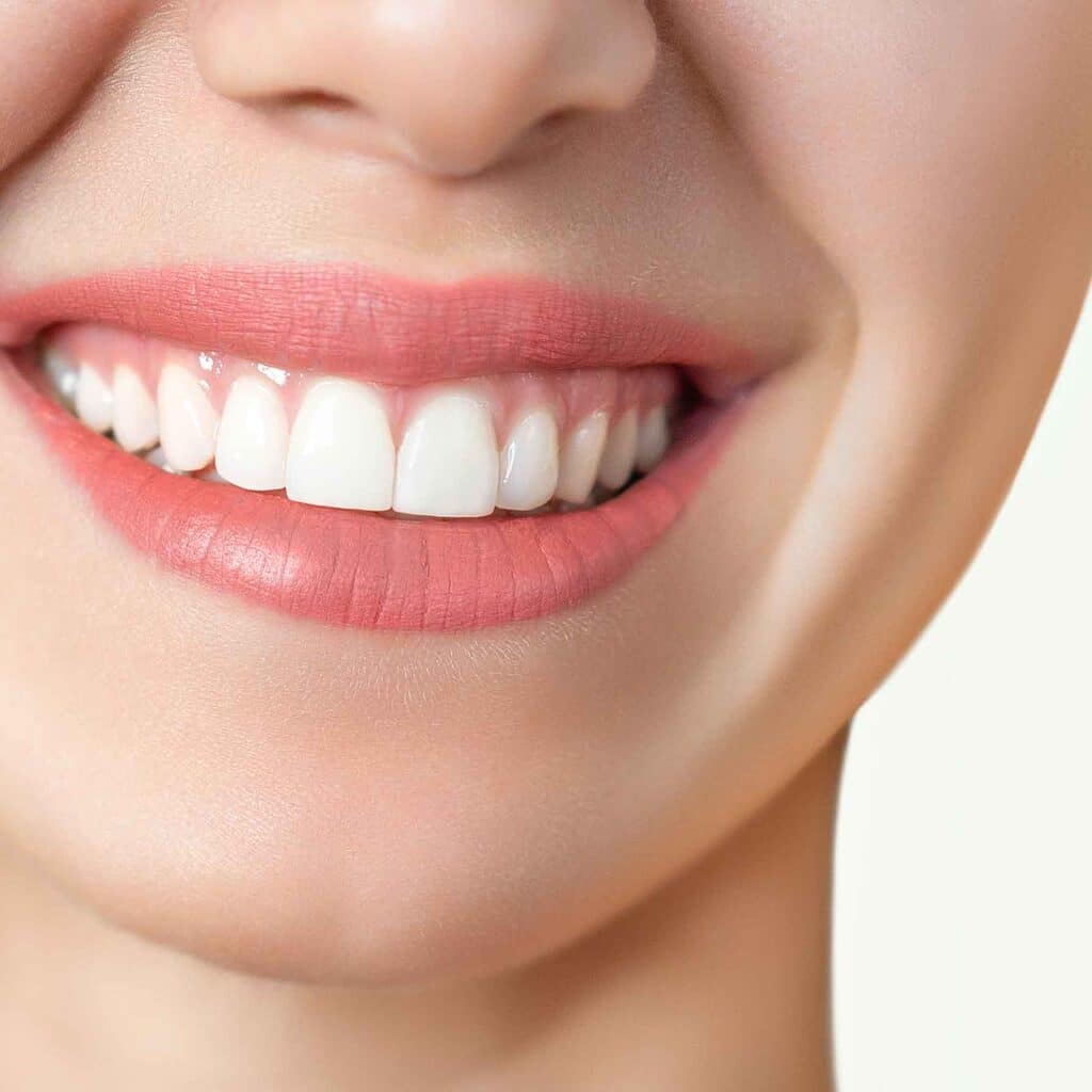 sourire-gingival-botox-acide-hyaluronique-gencive-toxine-botulique-clinique-confidence-lille-marcq-en-baroeul-17