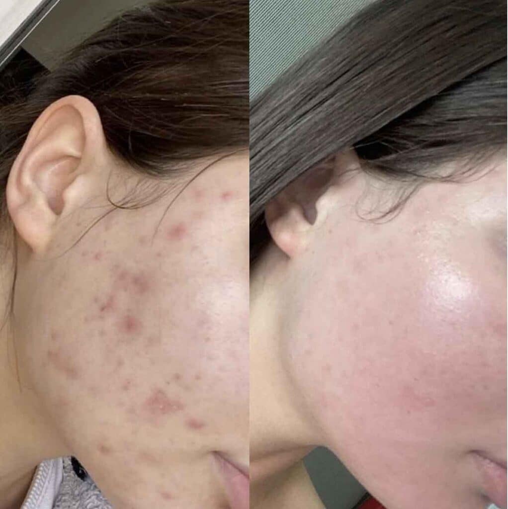 lasemd-ultra-baby-face-glow-acne-hyperpigmentation-melasma-taches-peau-traitement-soin-clinique-confidence-lille-marcq-en-baroeul-resultat-avant-apres-005