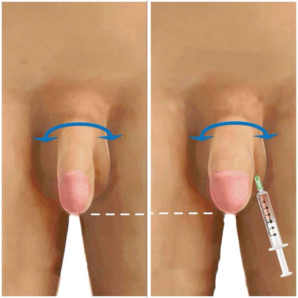 resultat-avant-apres-injection-acide-hyaluronique-penis-elargissement-001