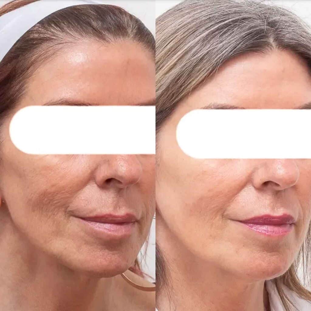 lasemd-ultra-baby-face-glow-acne-hyperpigmentation-melasma-taches-peau-traitement-soin-clinique-confidence-lille-marcq-en-baroeul-009