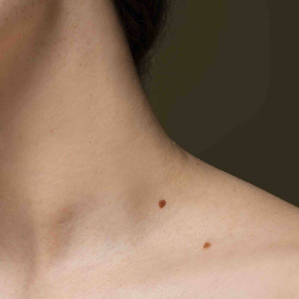 angiome-rubis-cause-danger-traitement-laser-medecin-prix-tarif-clinique-confidence-lille-marcq-en-baroeul-005