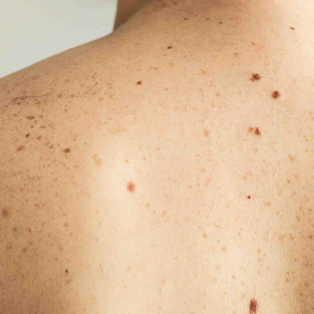 angiome-rubis-cause-danger-traitement-laser-medecin-prix-tarif-clinique-confidence-lille-marcq-en-baroeul-007
