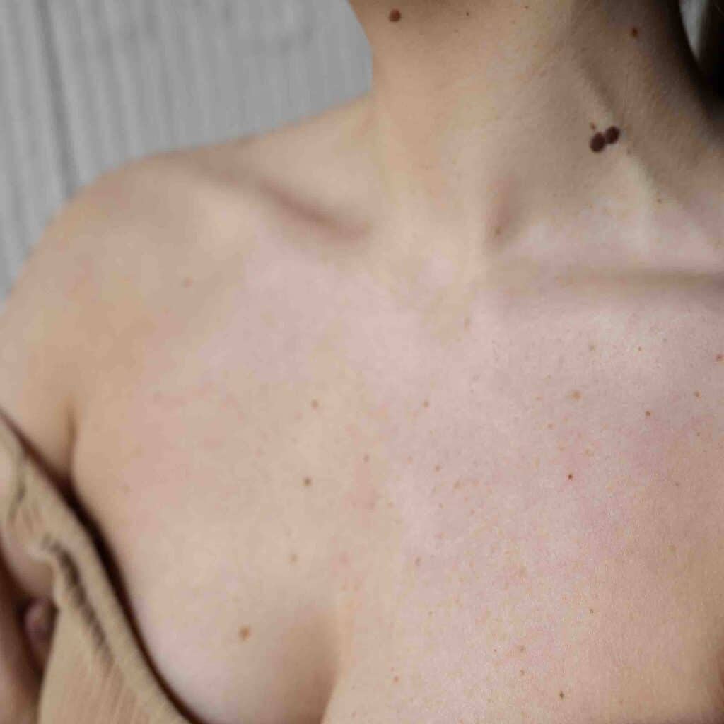 angiome-rubis-cause-danger-traitement-laser-medecin-prix-tarif-clinique-confidence-lille-marcq-en-baroeul-008