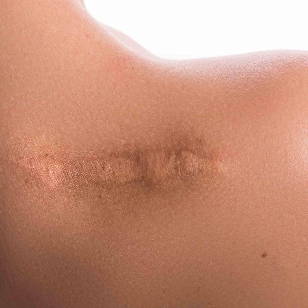 laser-pour-le-corps-epilation-detatouage-cicatrice-cheloide-acne-tache-soleil-vieillesse-angiome-rubis-cerise-lille-clinique-confidence-docteur-branczko-001