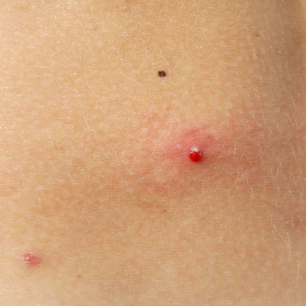 laser-pour-le-corps-epilation-detatouage-cicatrice-cheloide-acne-tache-soleil-vieillesse-angiome-rubis-cerise-lille-clinique-confidence-docteur-branczko-002