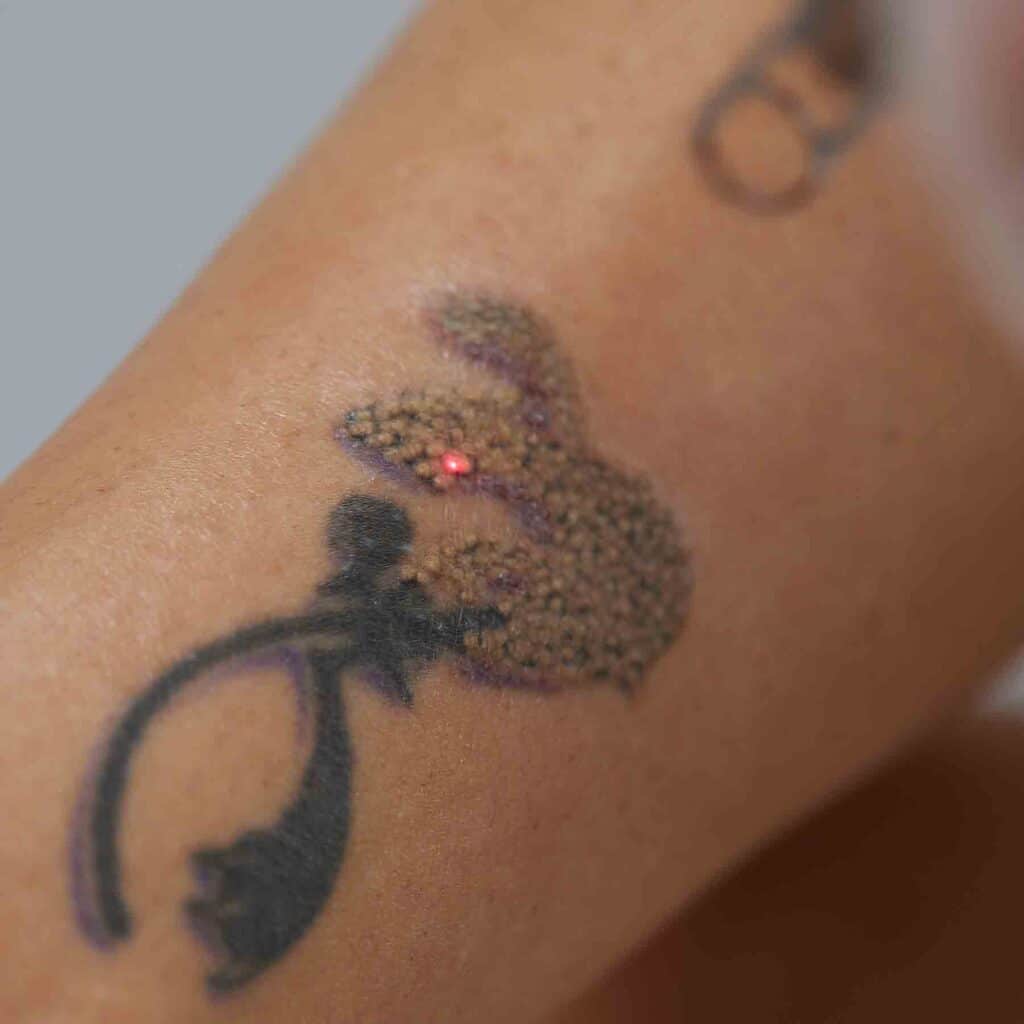 laser-pour-le-corps-epilation-detatouage-cicatrice-cheloide-acne-tache-soleil-vieillesse-angiome-rubis-cerise-lille-clinique-confidence-docteur-branczko-003