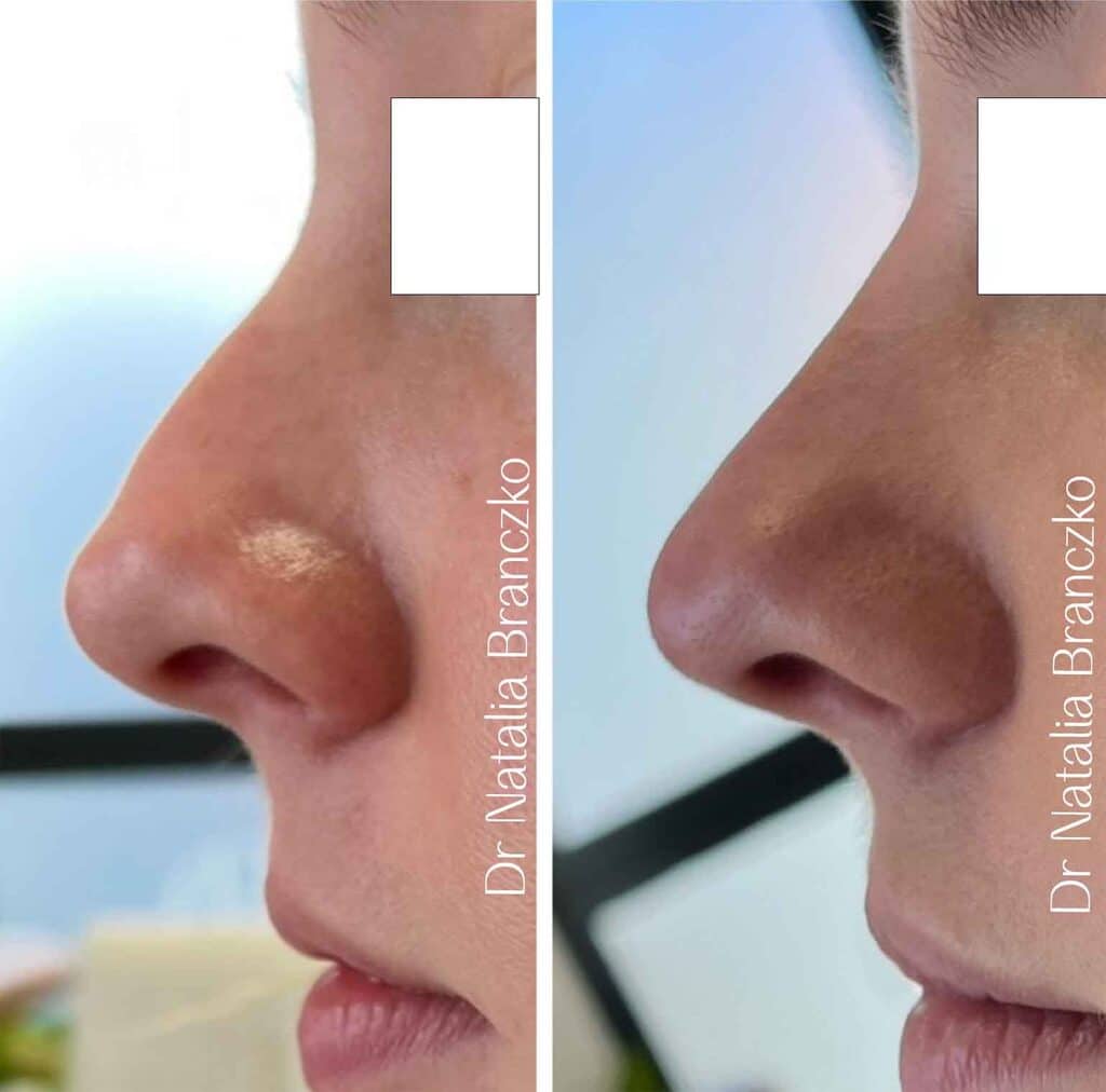 rhinoplastie-medicale-lille-acide-hyaluronique-sans-chirurgie-avant-apres-resultat-prix-tarif-nez-bosse-docteur-branczko-clinique-confidence-016