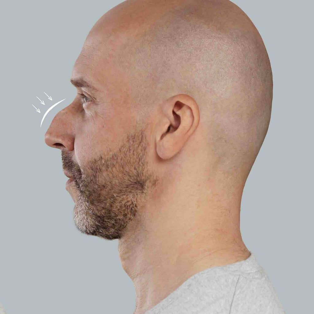 medecine-esthetique-traitement-homme-injections-cernes-rhinoplastie-epilation-detatouage-penoplastie-lasemd-sofwave-avis-resultat-avant-apres-006