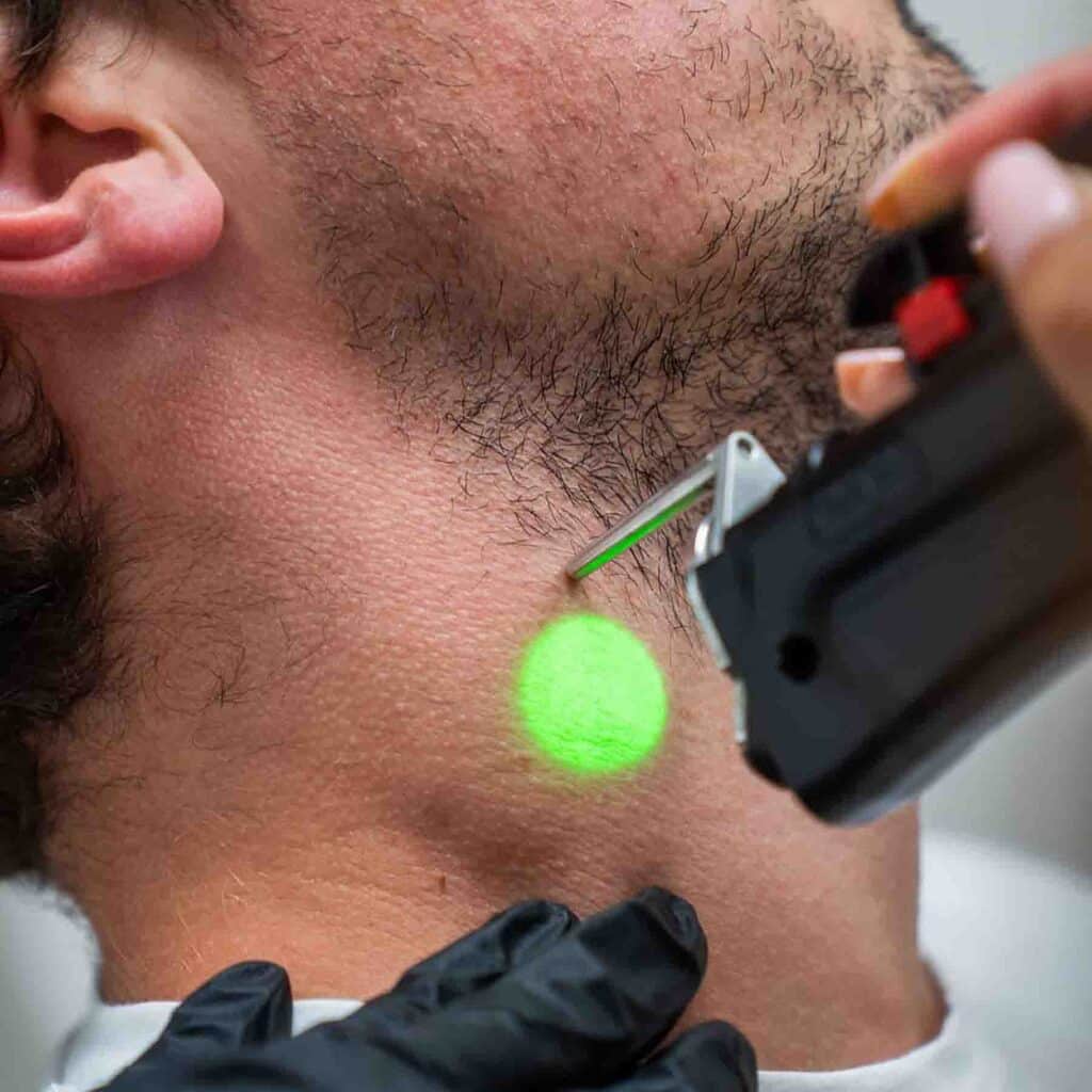 medecine-esthetique-traitement-homme-injections-cernes-rhinoplastie-epilation-detatouage-penoplastie-lasemd-sofwave-avis-resultat-avant-apres-007