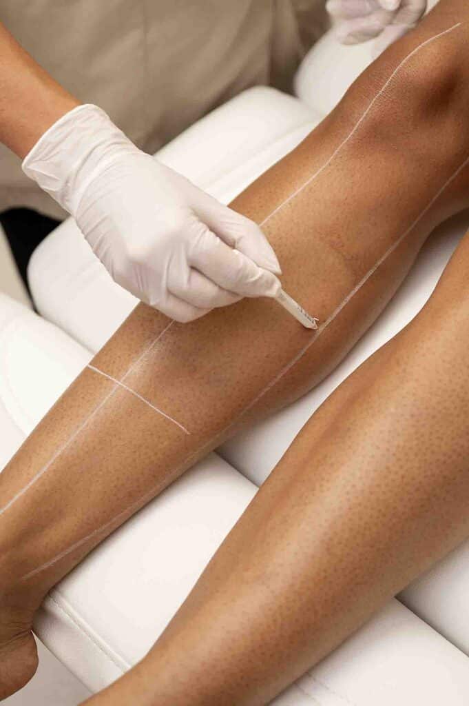 Epilation-laser-definitive-peau-mate-noire-yag-alexandrite-clinique-confidence-lille-dermatologue-esthetique-medical