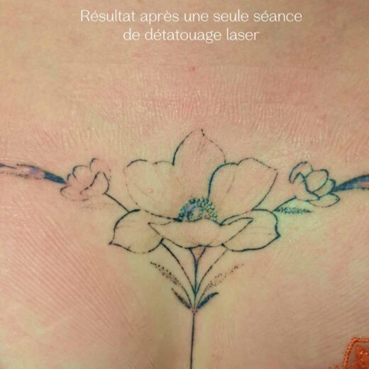 Détatouage laser pico à Lille : Effacez votre tatouage rapidement