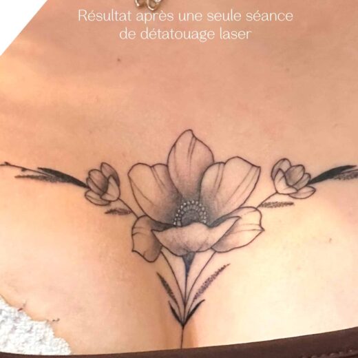 Détatouage laser pico à Lille : Effacez votre tatouage rapidement