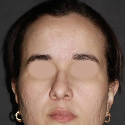 Skinboosters (mésothérapie)
