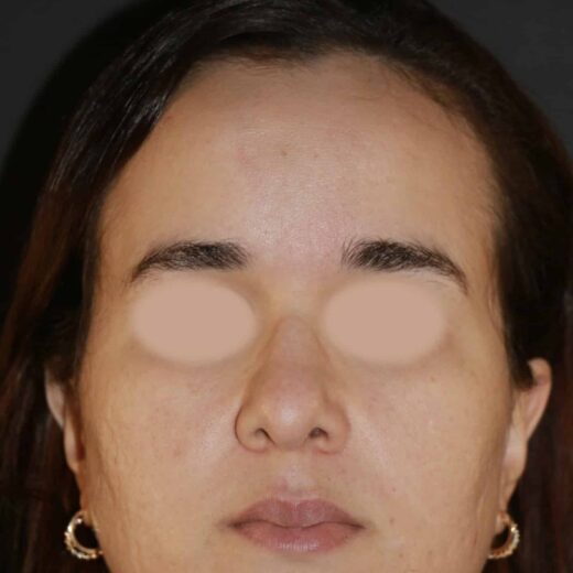 Skinboosters (mésothérapie)