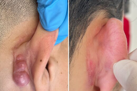Cicatrices chéloïdes : causes et traitements