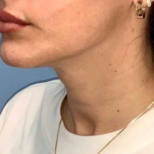 HIFU ou Sofwave : le meilleur choix pour un lifting du visage sans chirurgie ?