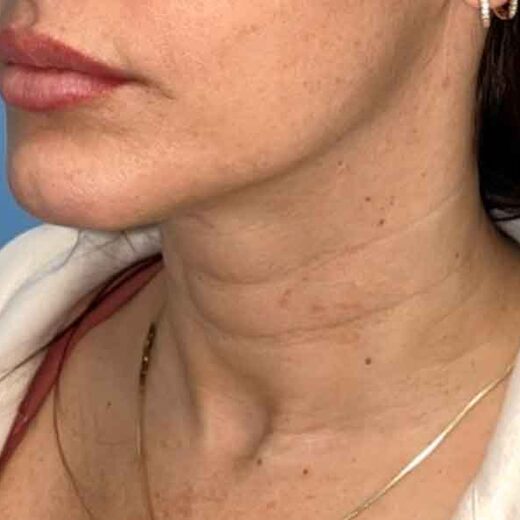 HIFU ou Sofwave : le meilleur choix pour un lifting du visage sans chirurgie ?