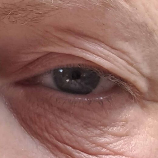 Sofwave à Lille : Lifting sans chirurgie pour une apparence rajeunie