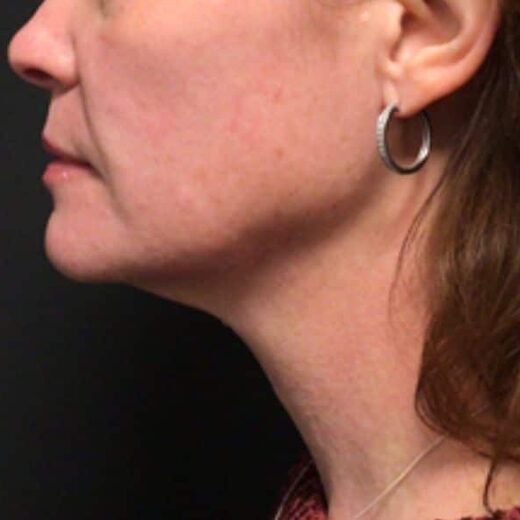Sofwave à Lille : Lifting sans chirurgie pour une apparence rajeunie
