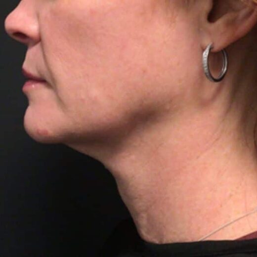 Sofwave à Lille : Lifting sans chirurgie pour une apparence rajeunie