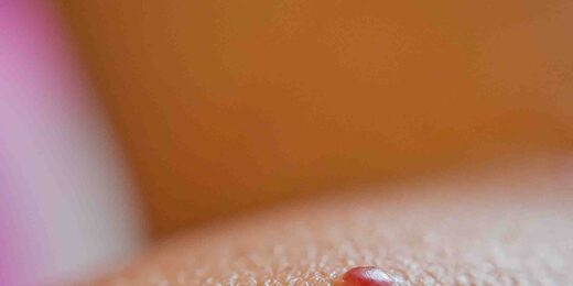 Angiome rubis : tout savoir sur les points rouges et leur traitement